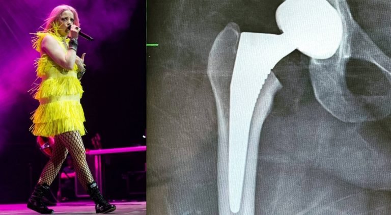 Shirley Manson de Garbage se sometió a una cirugía de cadera